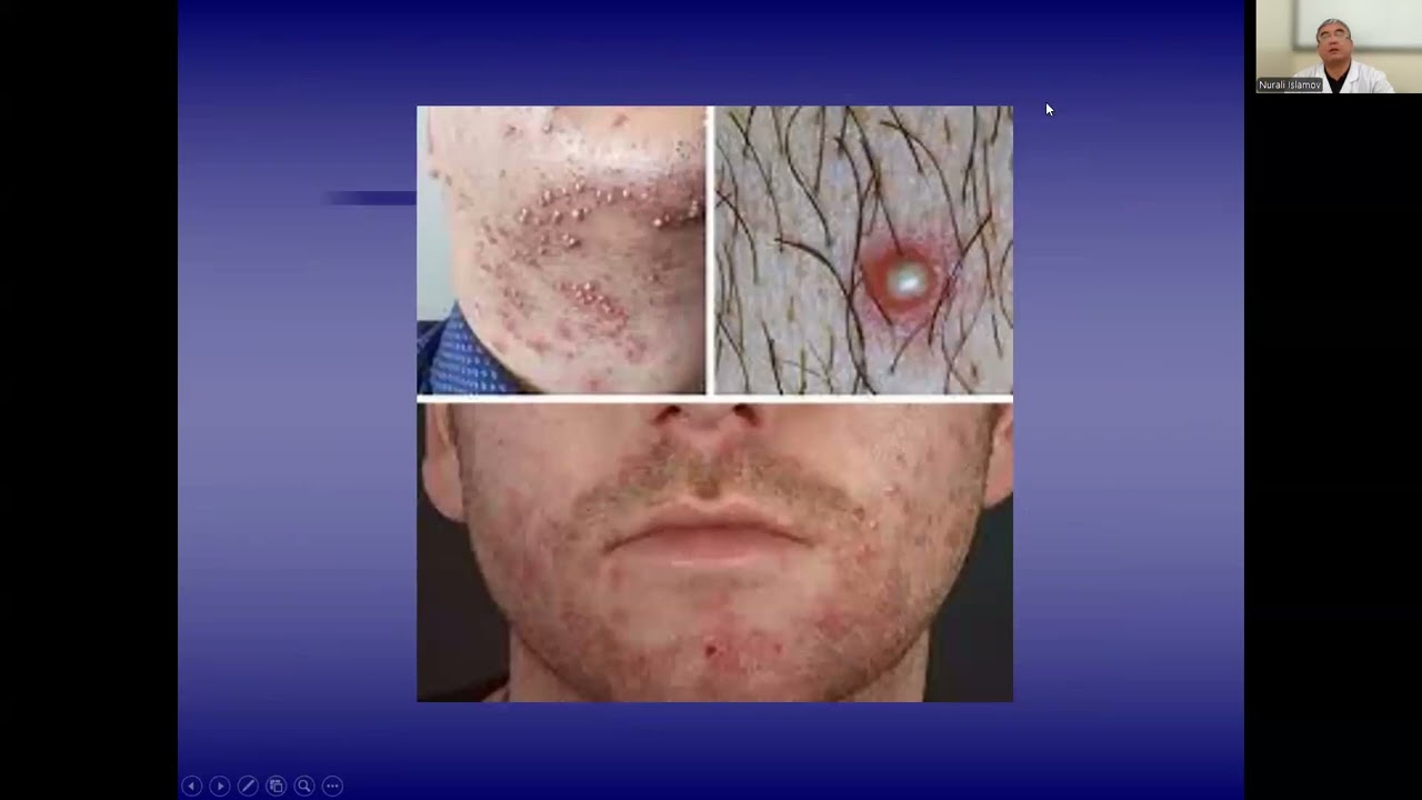 Terining yiringli kasalliklari piodermitlar