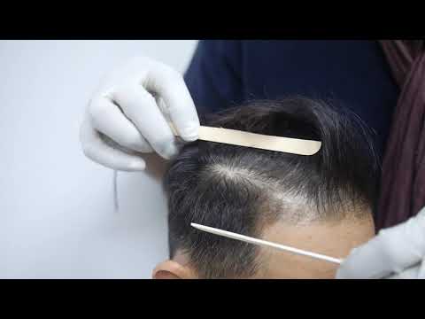 Hair Transplant - Dr Ruban (NSHLC) Consultant Dermatologist & Hair Transplant Surgeon In KL Malaysia