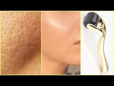 HOW TO GET CLEAR GLOWING SKIN, SPOTLESS SKIN WITH DERMA ROLLER │GET RID OF ACNE, LARGE PORES, SPOTS Video