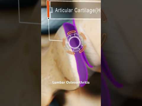 Lumbar Osteoarthritis