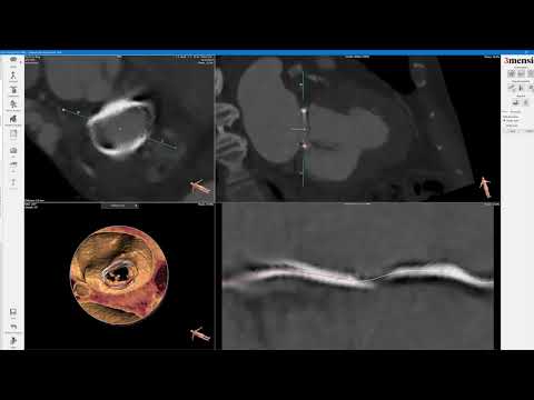 3Mensio CT Pre-Case Planning: Mitral Valve-in-Ring (MVIR) TMVR
