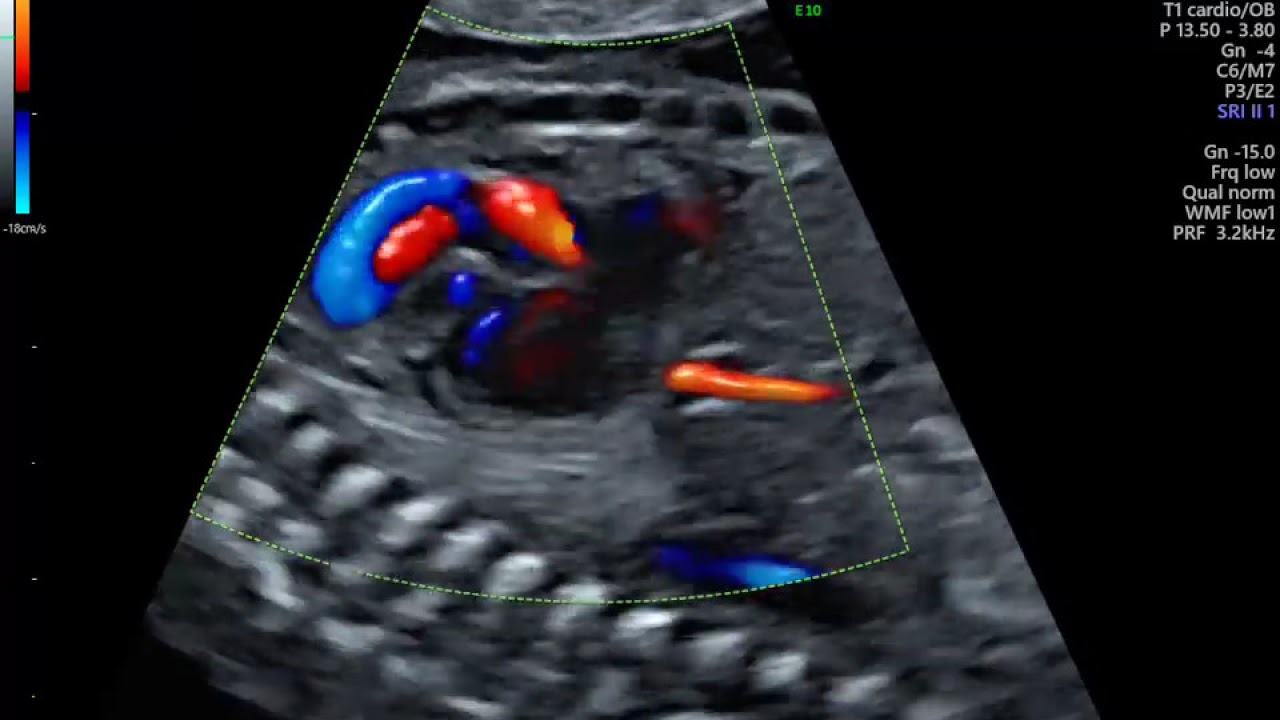 ECOCARDIOGRAFIA FETAL COM DOPPLER COLORIDO