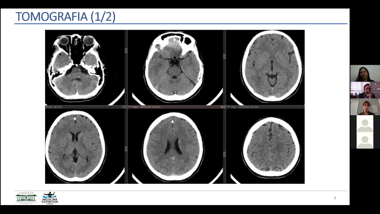 CONCUSSÃO NO ESPORTE