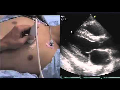 Intro to Echo Parasternal Views.mov