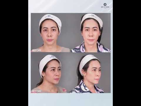 ฟิลเลอร์ Belotero ดีอย่างไร? ฟิลเลอร์ Belotero ดีอย่างไร?