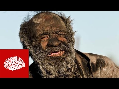 Ein starker Rückgang der Blutdruck Symptome Akuter hypertensive 4 Buchstaben