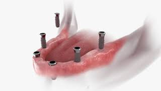 ¿Qué es una protesis fija de zirconio sobre 6 implantes- Clínica Bocas Nuevas