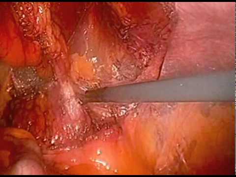 Zastosowanie Zautomatyzowanych I Laparoskopowych Procedur W Pediatrii (1/2)