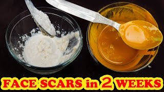 3 HOMEMADE MASK FOR ACNE SCARS | DIY FACE MASK FOR ACNE SCARS
