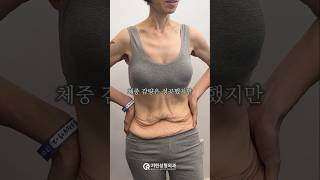 바디 리프트 성형 시술