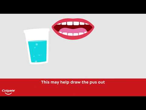 How To Treat a Gum or Tooth Abscess | Colgate®