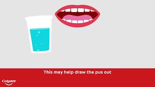How To Treat a Gum or Tooth Abscess | Colgate®