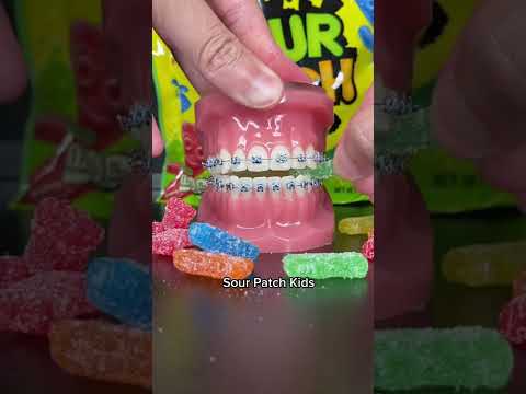 Foods to avoid with Braces 👊