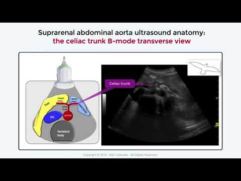Celiac Trunk ultrasound appearance  vascular ultrasound learning