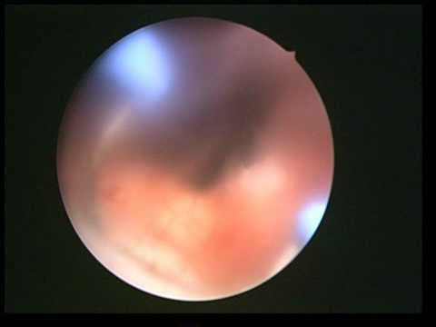 Internationales Protokoll zur Behandlung von Prostatakrebs Einige Kerzen die Prostata bei Männern nehmen