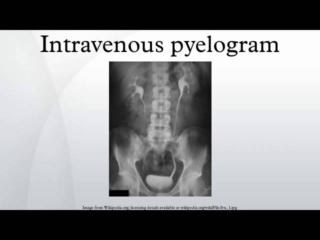 Understanding Intravenous Pyelogram: Procedure, Uses, and Assessments ...