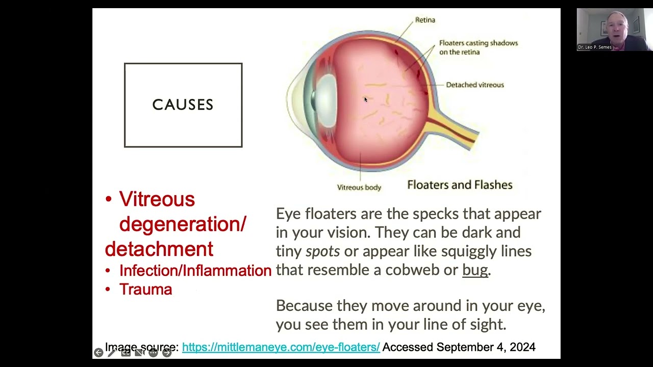 Flashes & Floaters  Was That a Bug that Just Flew into My Eye  Featuring Dr Semes 10-24