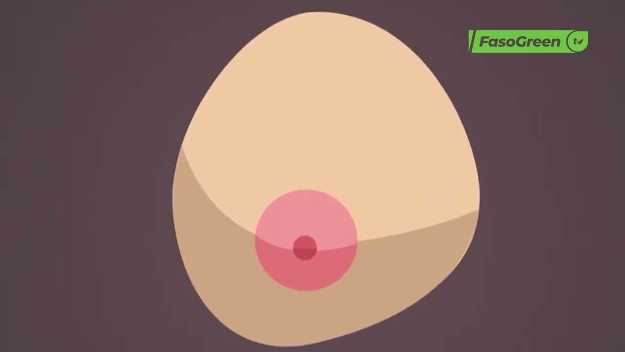 Cancer du sein : Tout savoir avec le Docteur YAMÉOGO