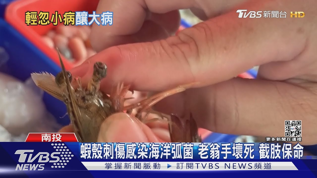 蝦殼刺傷感染海洋弧菌!老翁手壞死 截肢保命