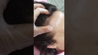 Scalp Microblading Receding Hair Line by El Truchan
