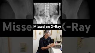 One Missed Sacral Injury Changed Her Entire Spine