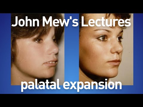 John Mew's lectures part 18: palatal expansion