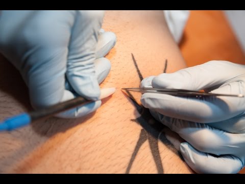 Elektro-Epilation | Nadelepilation | Haarentfernung für immer - professionell und sicher