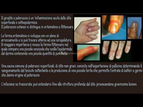 Come liberarsi da eczema nel modo nazionale Il menù per le madri nutrenti a dermatite atopic