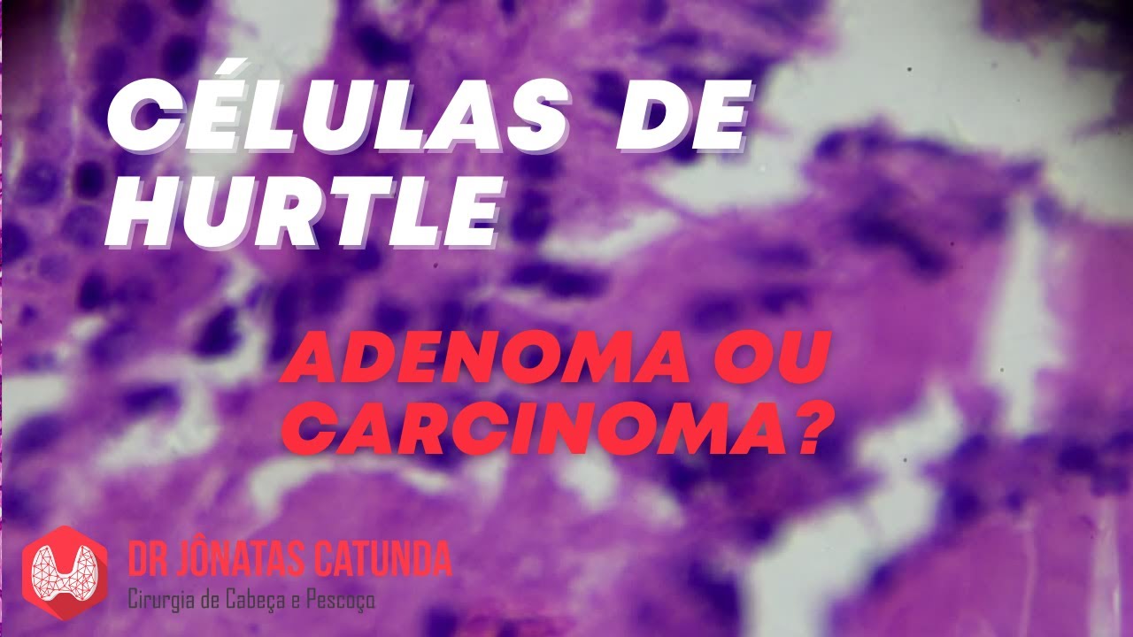 Células de Hurtle - Bethesda IV: Neoplasia folicular, adenoma ou carcinoma