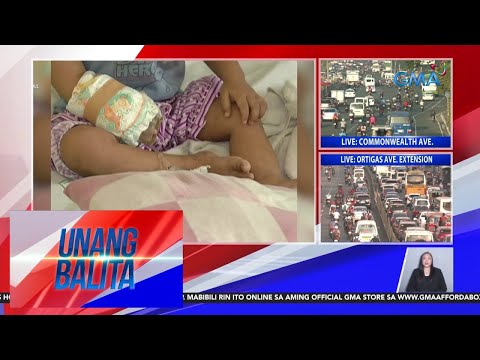 DOH – Kaso ng measles sa bansa, bumaba rin Unang Balita