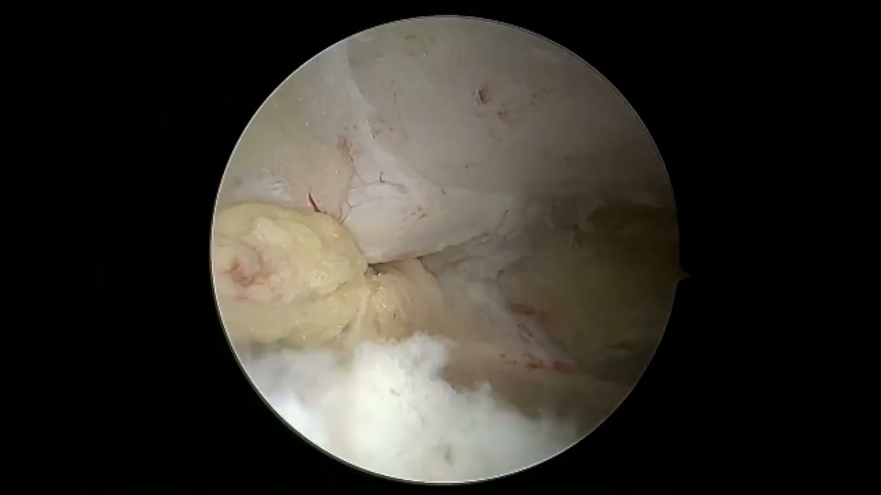 Check out Dr. Garcia’s new innovative technique for AC joint reconstruction.