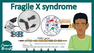 Fragile X syndrome | Genetics, cell biology and pathology of Fragile X syndrome | USMLE Step 1