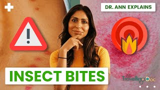 Insect Bites: How to Tell What Bit You (Pictures + When to Worry)#doctor #insectbite