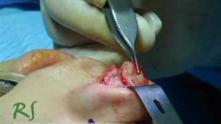 Live Rhinoplasty | Nose Job Technique