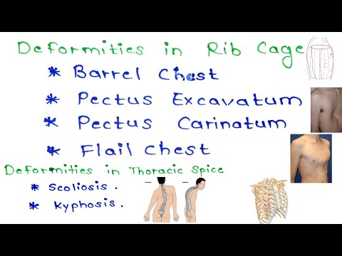Chest Wall Deformities |Scoliosis|Barrel Chest |Pegion and funnel Chest || Medical Minion (Thorax 3)