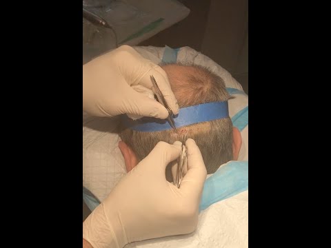 Inside a Hair Transplant Procedure - Hair Fix Friday - John Frank, MD