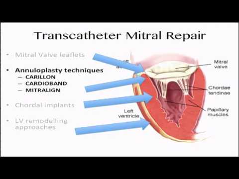 14 - State of the Art Percutanous Approach for the Mitral Valve - Anita Asgar