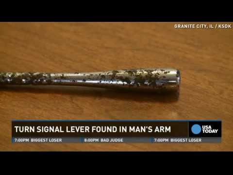 Turn signal lever removed from man's arm after 51 years