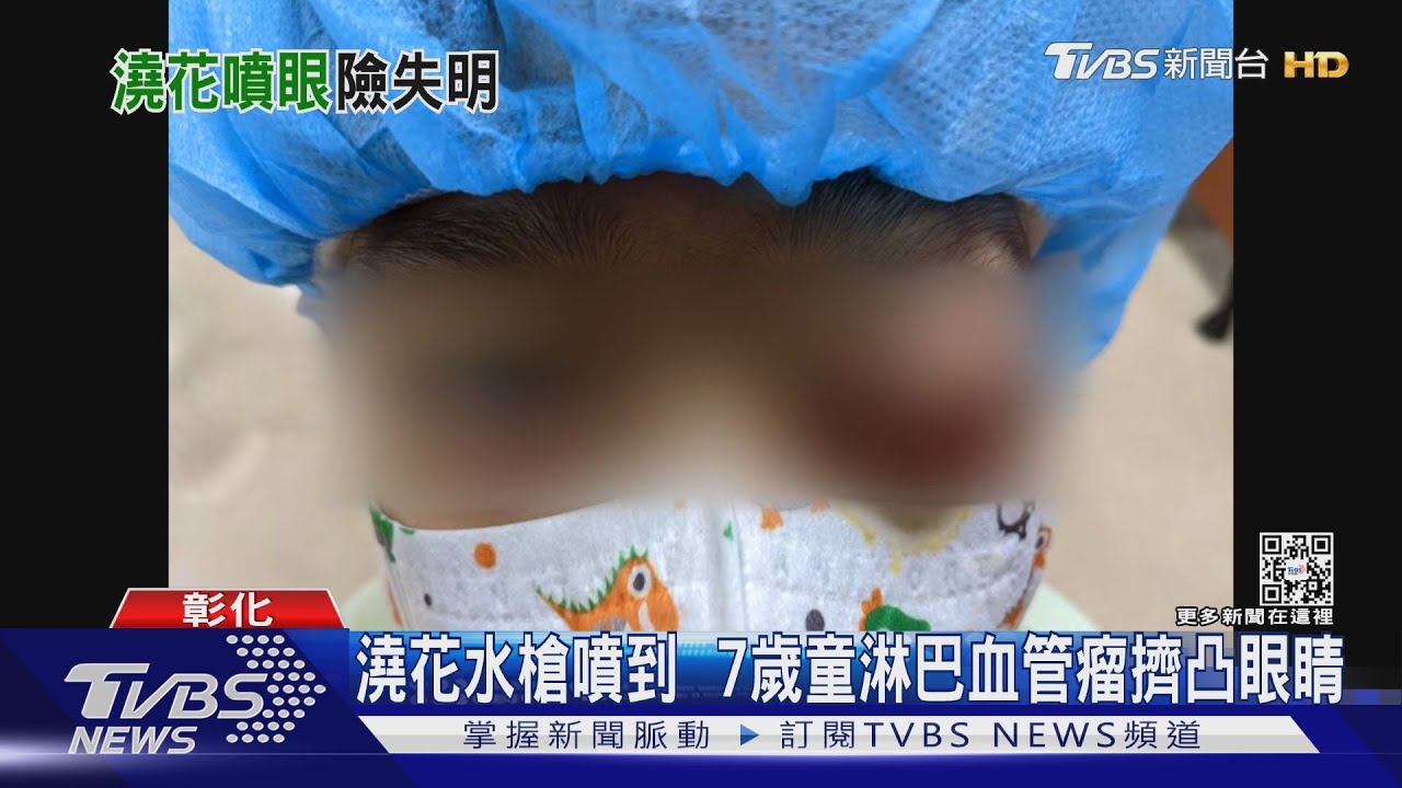 澆花水槍噴到　7歲童淋巴血管瘤擠凸眼睛