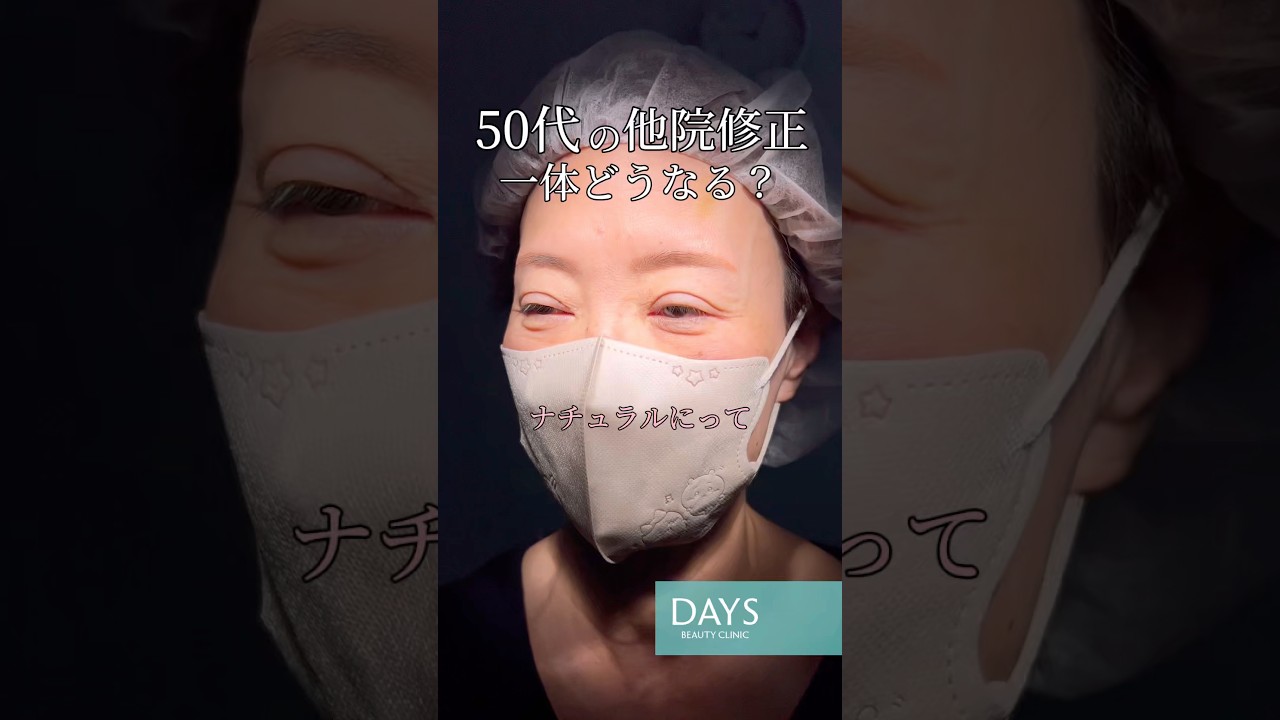 【二重整形】衝撃のビフォーアフター！#shorts