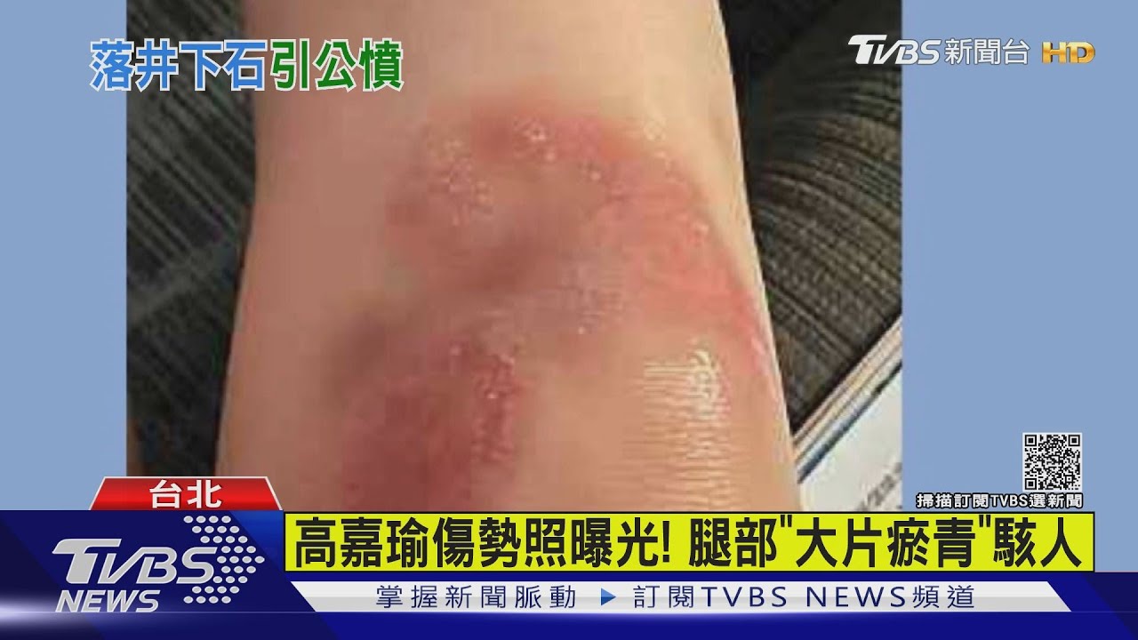 高嘉瑜傷勢照曝光！　腿部「大片瘀青」駭人