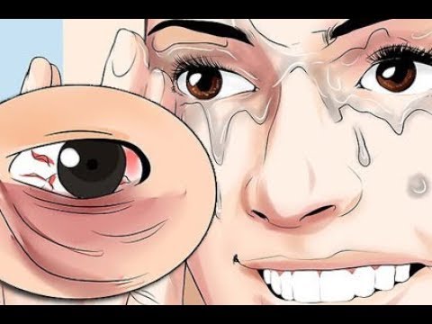 Das Ekzem der Standard der Hilfeleistung Das Ekzem auf den Händen von der Konstipation