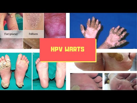 Body cures hpv