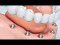 Remplacement de toutes les dents : prothèse fixe - le saviez-vous ?