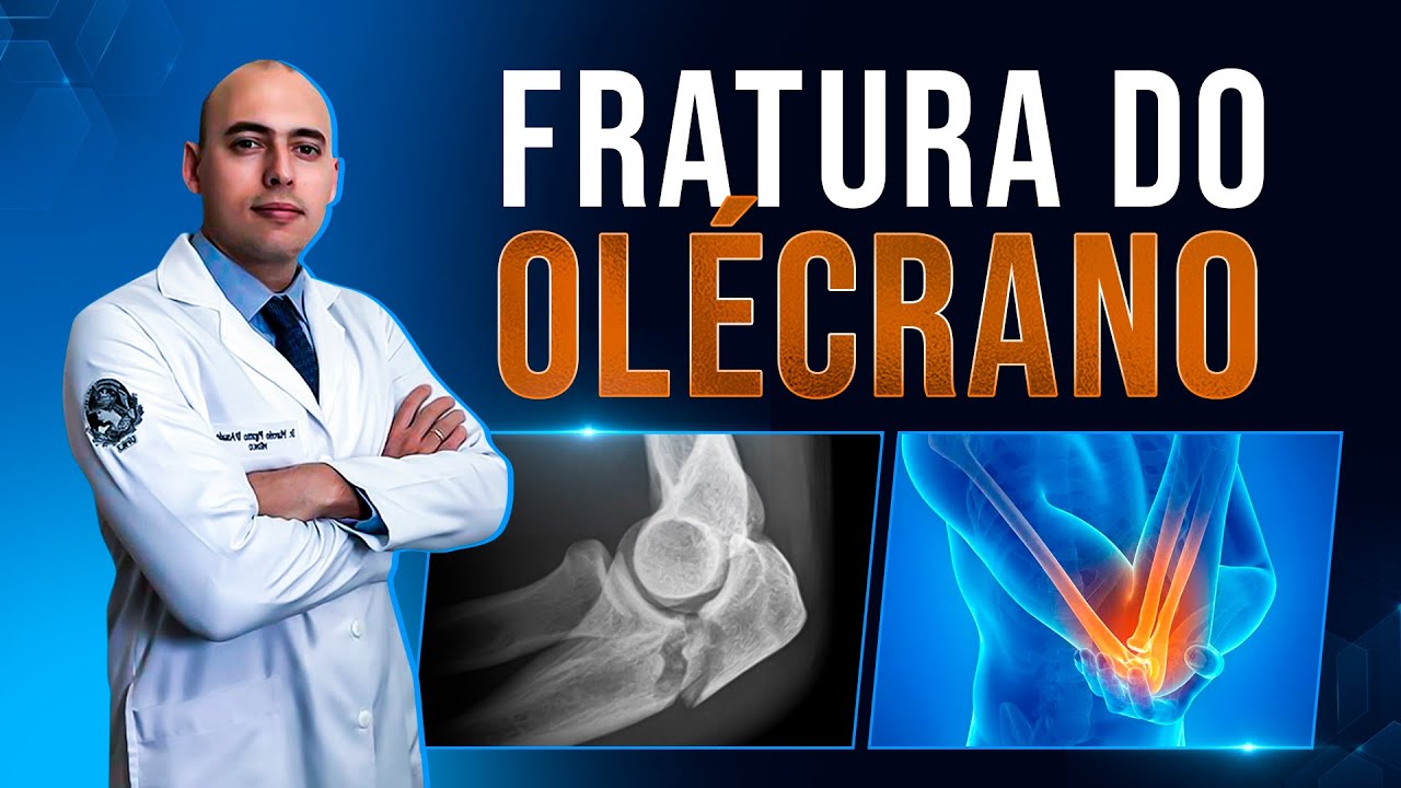 FRATURA NO OLÉCRANO | COTOVELO | TUDO QUE VOCÊ PRECISA SABER!