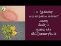 படர்தாமரை சீக்கிரம் மறைய இது போதும் Ri