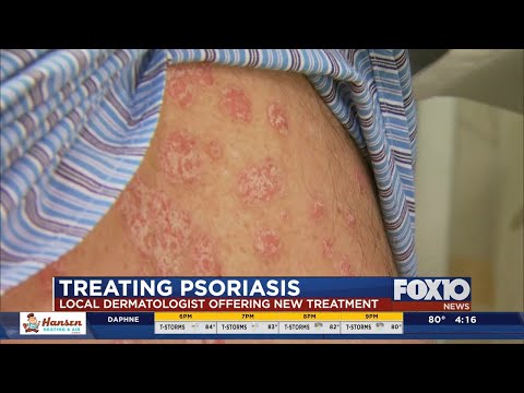 New treatment for psoriasis
