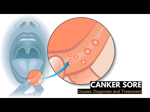 What is CANKER SORES? Causes, Signs and Symptoms, Diagnosis and Treatment.