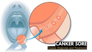 What is CANKER SORES? Causes, Signs and Symptoms, Diagnosis and Treatment.