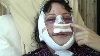 Facial Plastic Surgery Recovery: Day 1